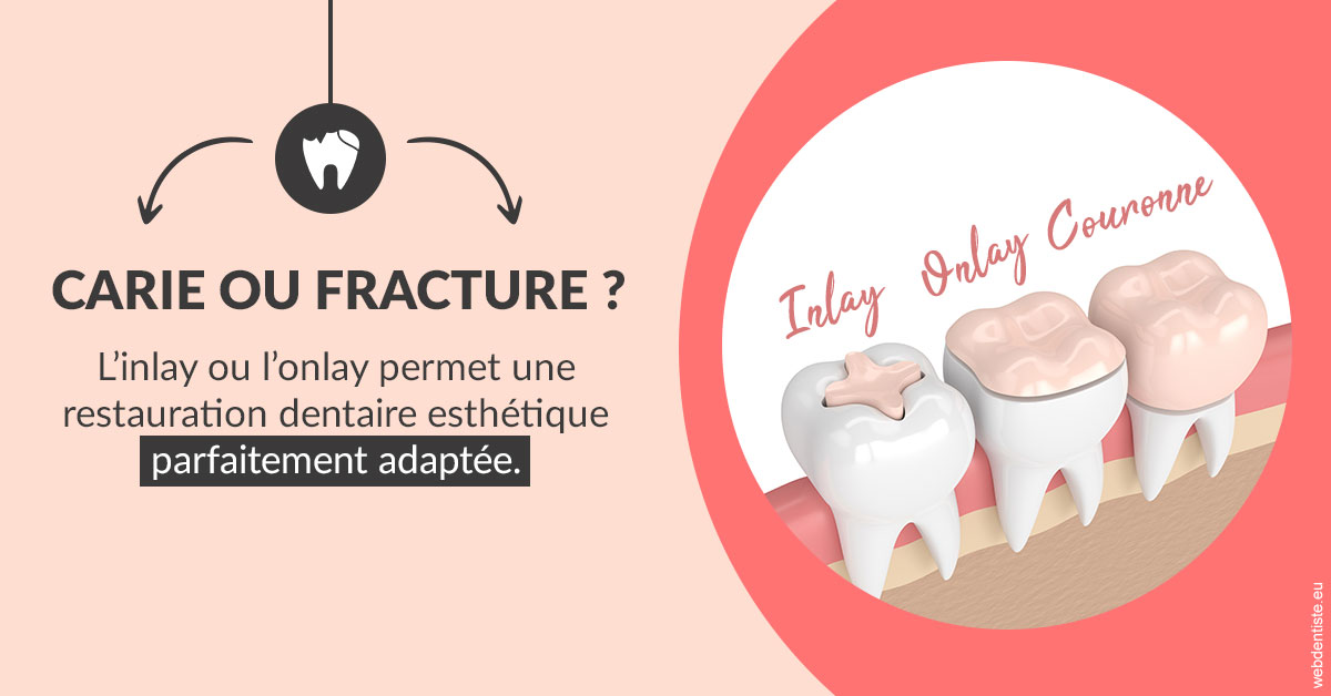 https://dr-levi-ted.chirurgiens-dentistes.fr/T2 2023 - Carie ou fracture 2