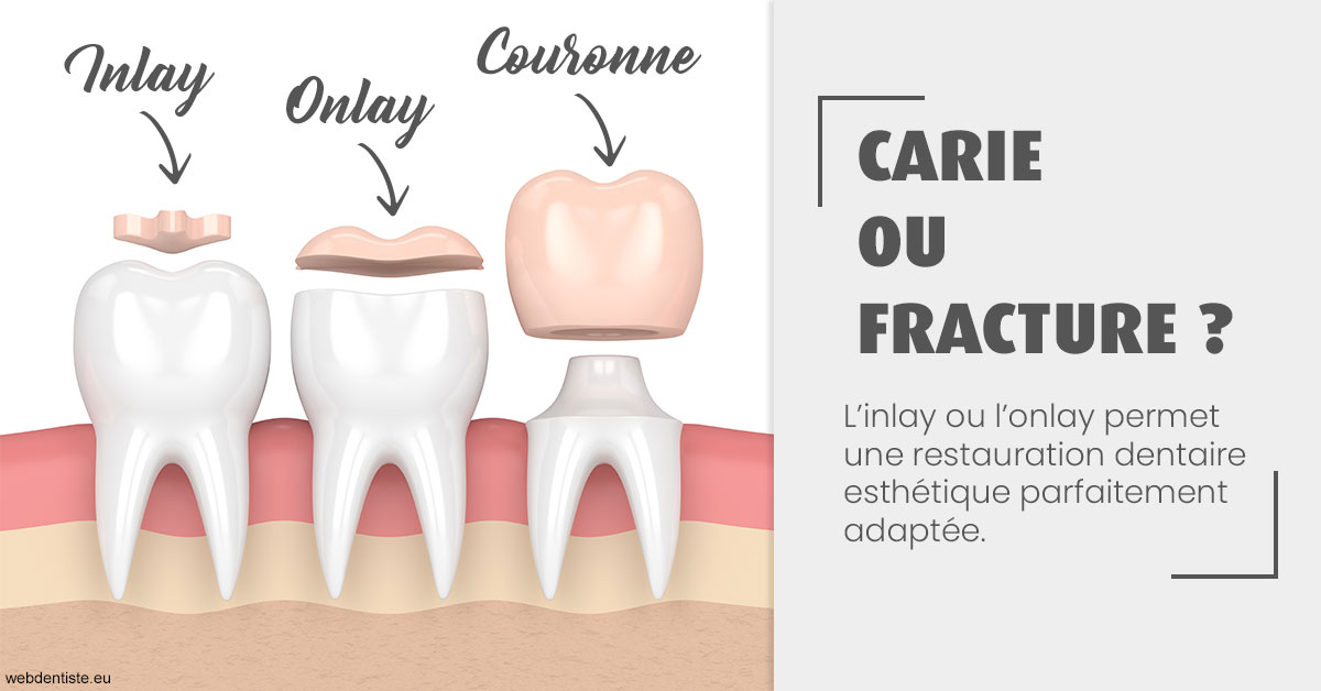 https://dr-levi-ted.chirurgiens-dentistes.fr/T2 2023 - Carie ou fracture 1