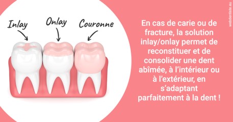 https://dr-levi-ted.chirurgiens-dentistes.fr/L'INLAY ou l'ONLAY 2