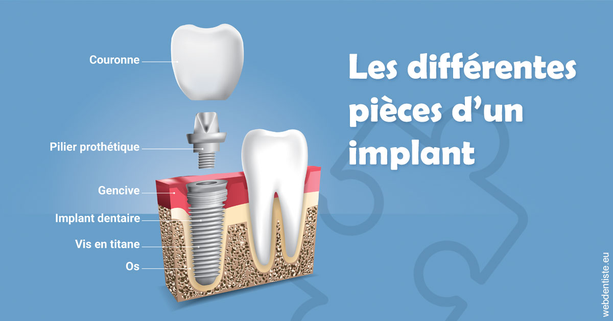 https://dr-levi-ted.chirurgiens-dentistes.fr/Les différentes pièces d’un implant 1